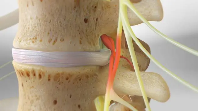 MITŐL ALAKUL KI A PORCKORONGSÉRV? MITŐL ALAKUL KI A PORCKORONGSÉRV?