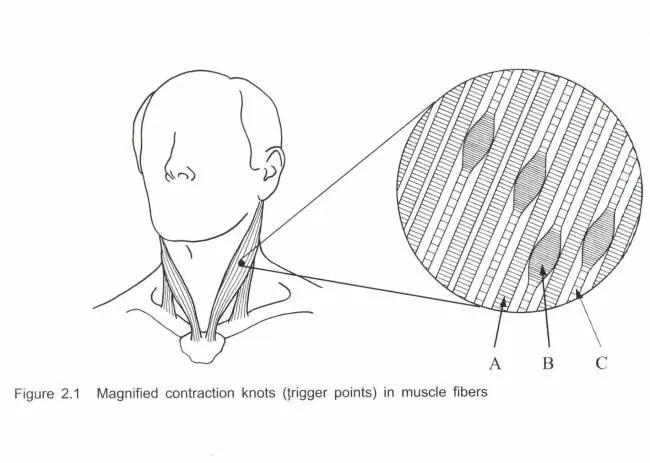 Trigger pontok a nyaki izomrostokban Trigger pontok a nyaki izomrostokban