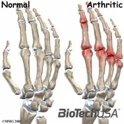 A kezek rheumatoid arthritis tünetei