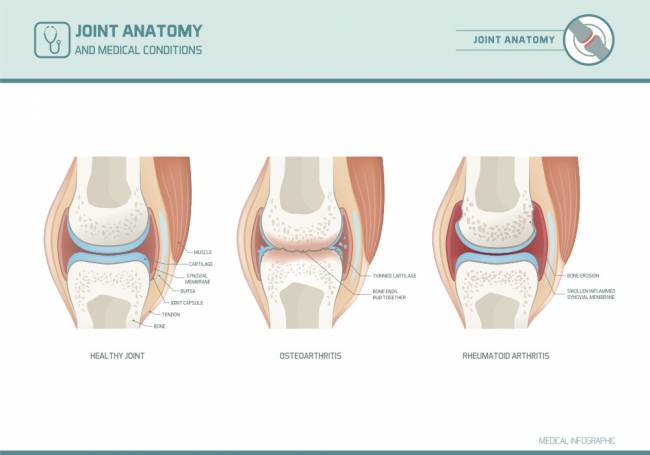 ízületi gyulladás osteoarthritis ízületek