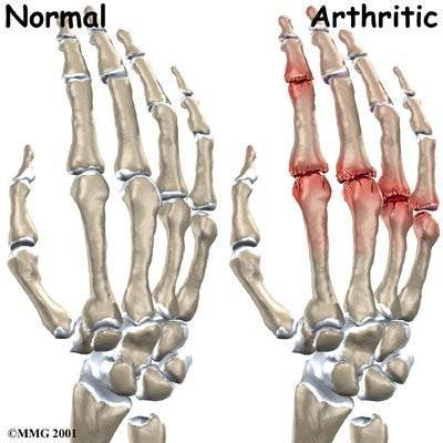 ízületi deformációk rheumatoid arthritisben)